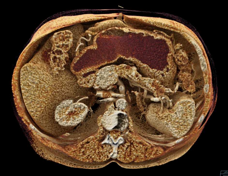 Carcinoma Body of the Pancreas - CTisus CT Scan