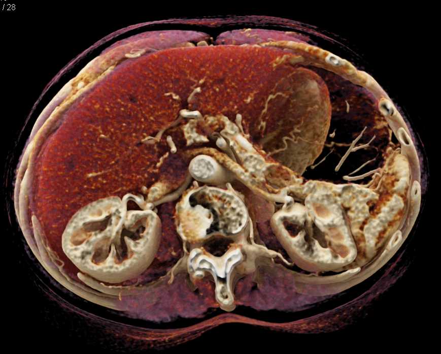 Cystic Neuroendocrine Tumor Tail of Pancreas - CTisus CT Scan