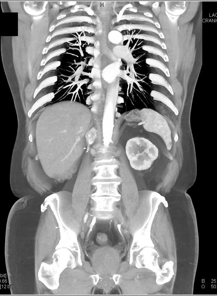 Metastatic Renal Cell Carcinoma to the Right Adrenal - CTisus CT Scan