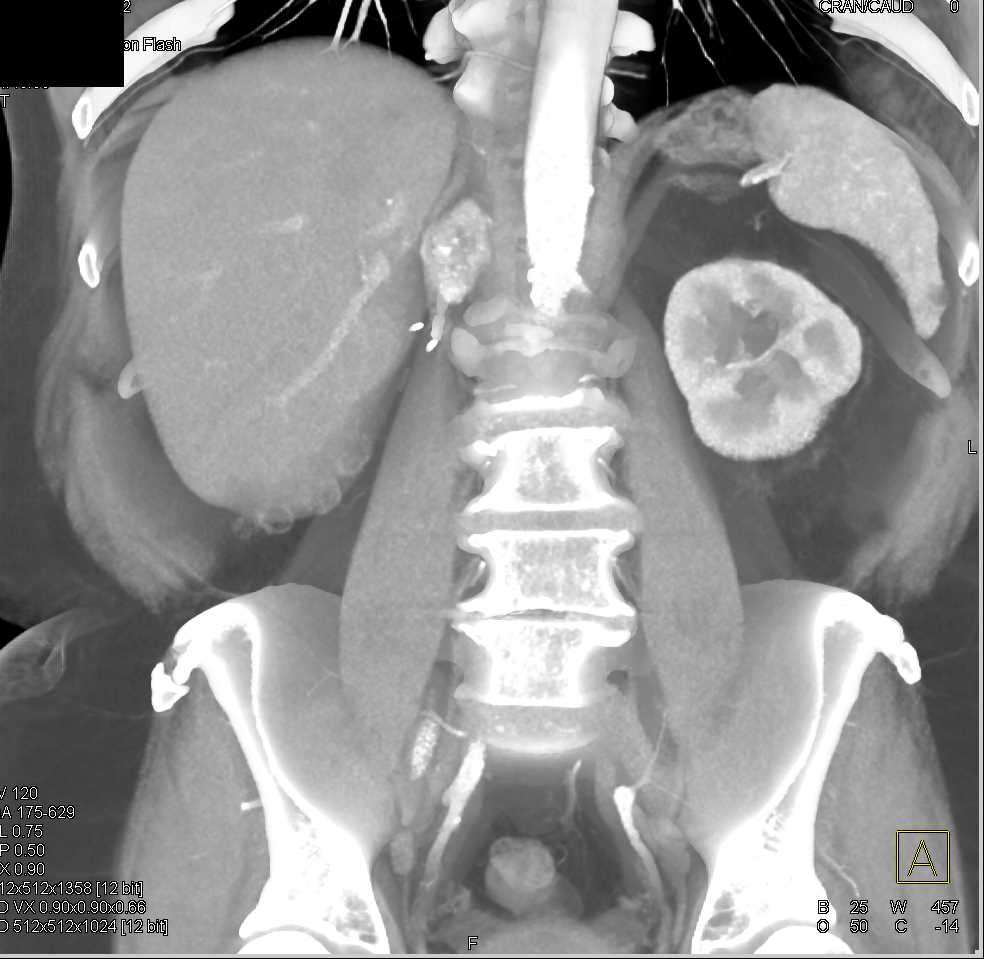 Metastatic Renal Cell Carcinoma to the Right Adrenal - CTisus CT Scan