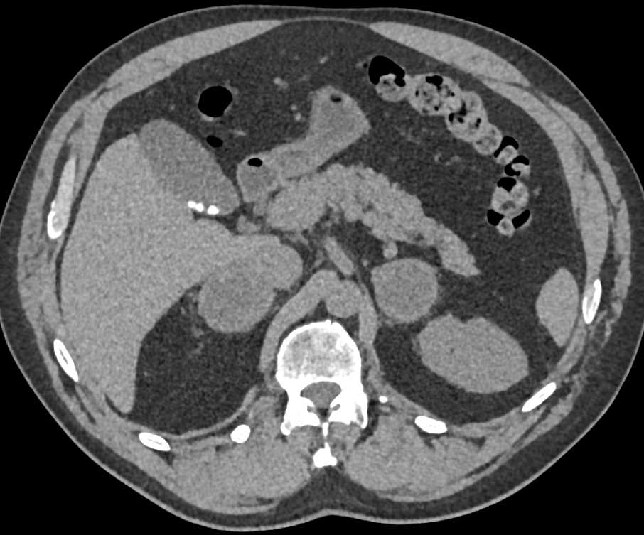 Metastatic Renal Cell Carcinoma to Adrenals and Lung - CTisus CT Scan