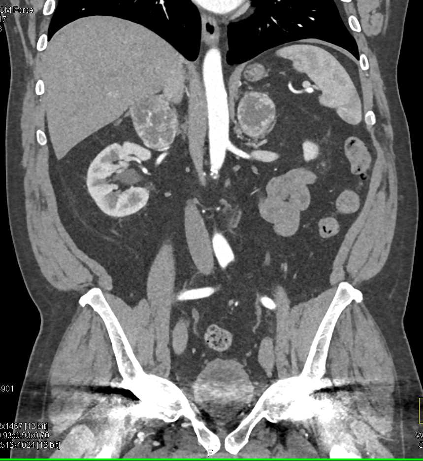 Metastatic Renal Cell Carcinoma to Adrenals and Lung - CTisus CT Scan