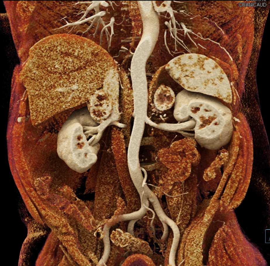 kidney adrenal gland cancer