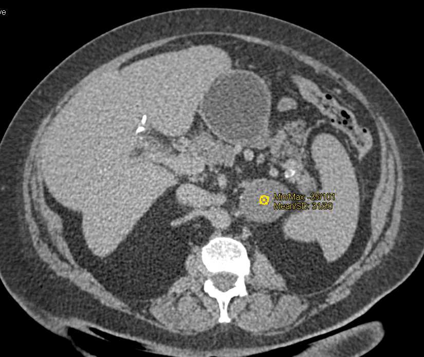 Old Adrenal Hematoma with Calcification - CTisus CT Scan