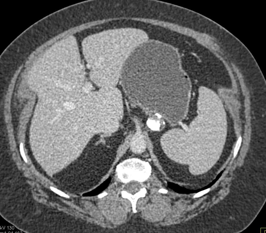 Old Adrenal Hematoma with Calcification - CTisus CT Scan