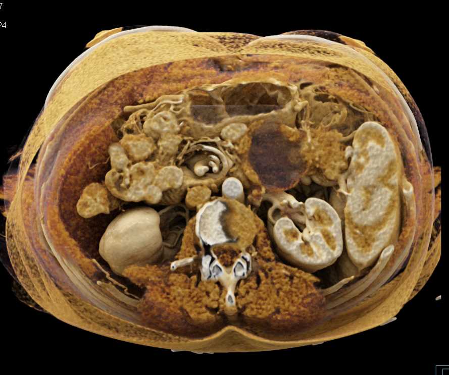 Pancreas Adenocarcinoma with Cinematic Rendering - CTisus CT Scan