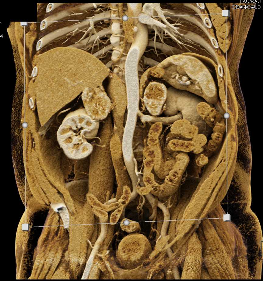 Metastatic Renal Cell Carcinoma to the Adrenal Glands - CTisus CT Scan