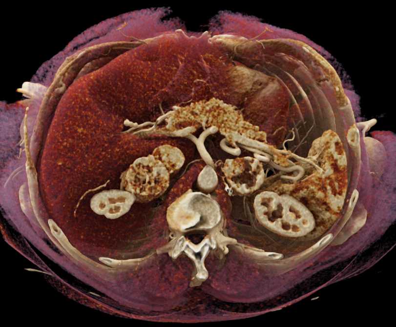 Metastatic Renal Cell Carcinoma to the Adrenal Glands - CTisus CT Scan