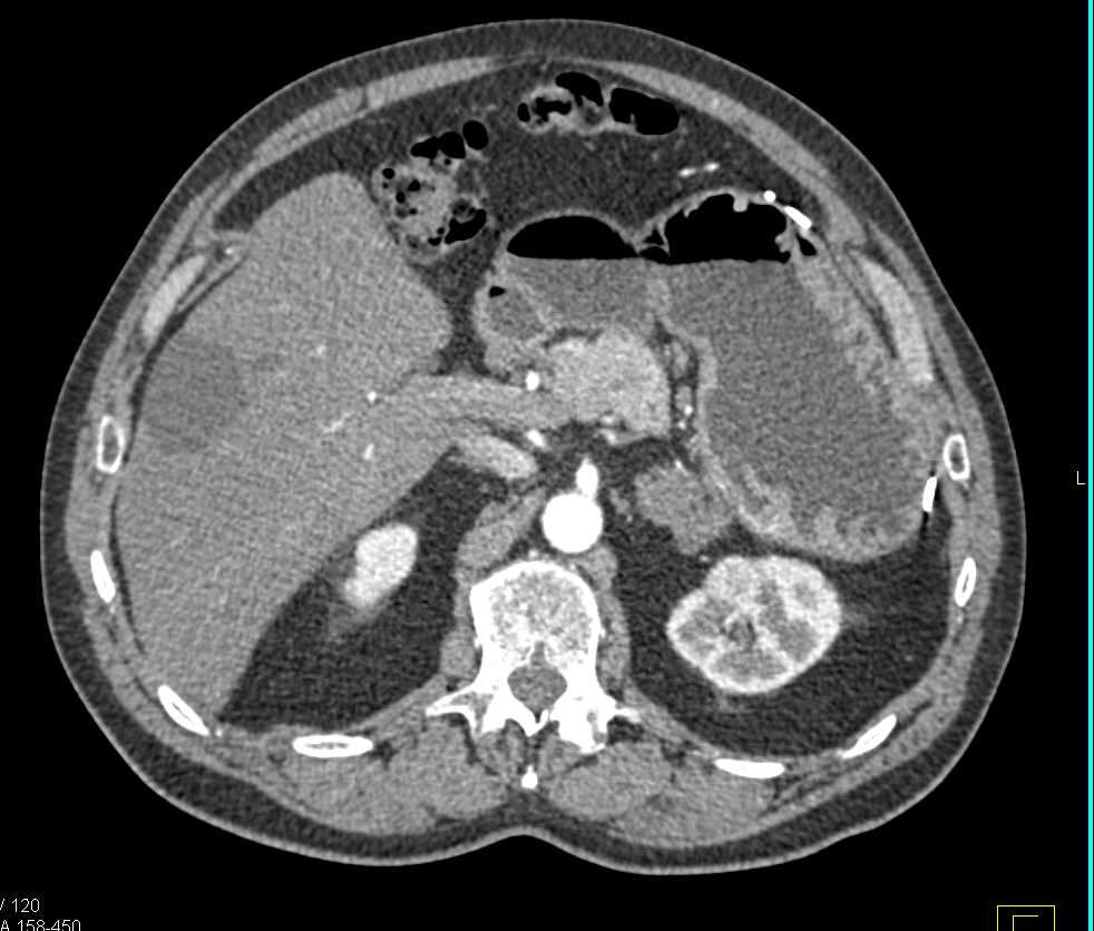Myelolipoma Left Adrenal Gland - CTisus CT Scan