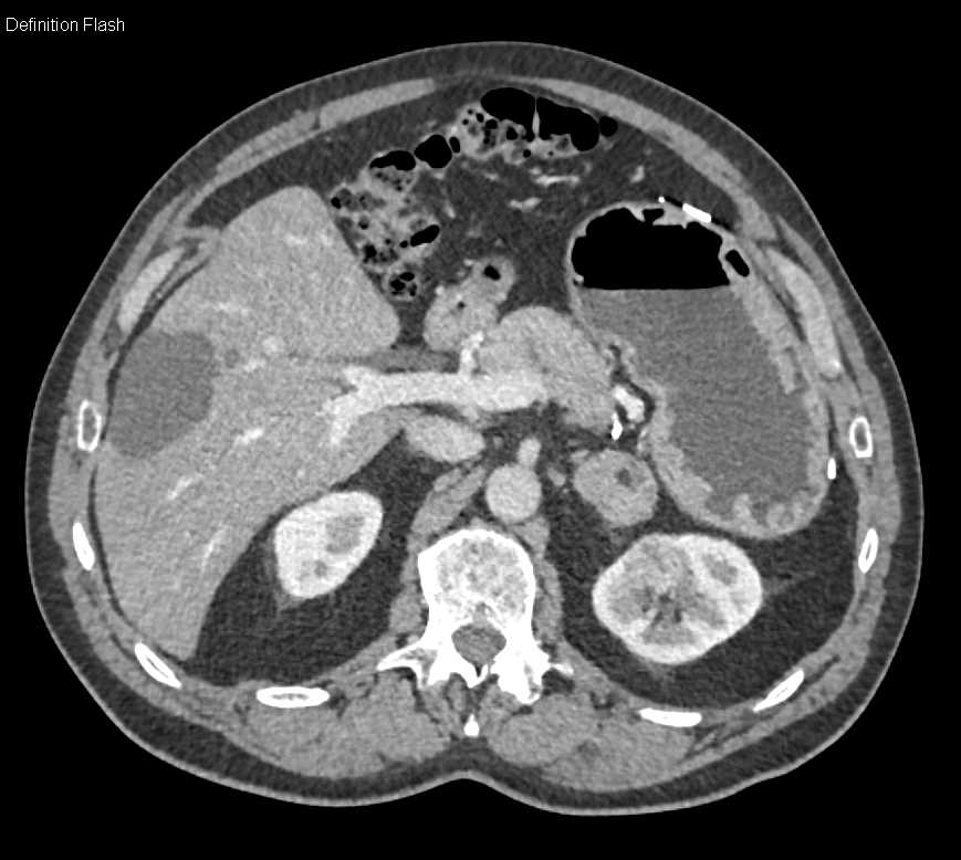 Myelolipoma Left Adrenal Gland - CTisus CT Scan