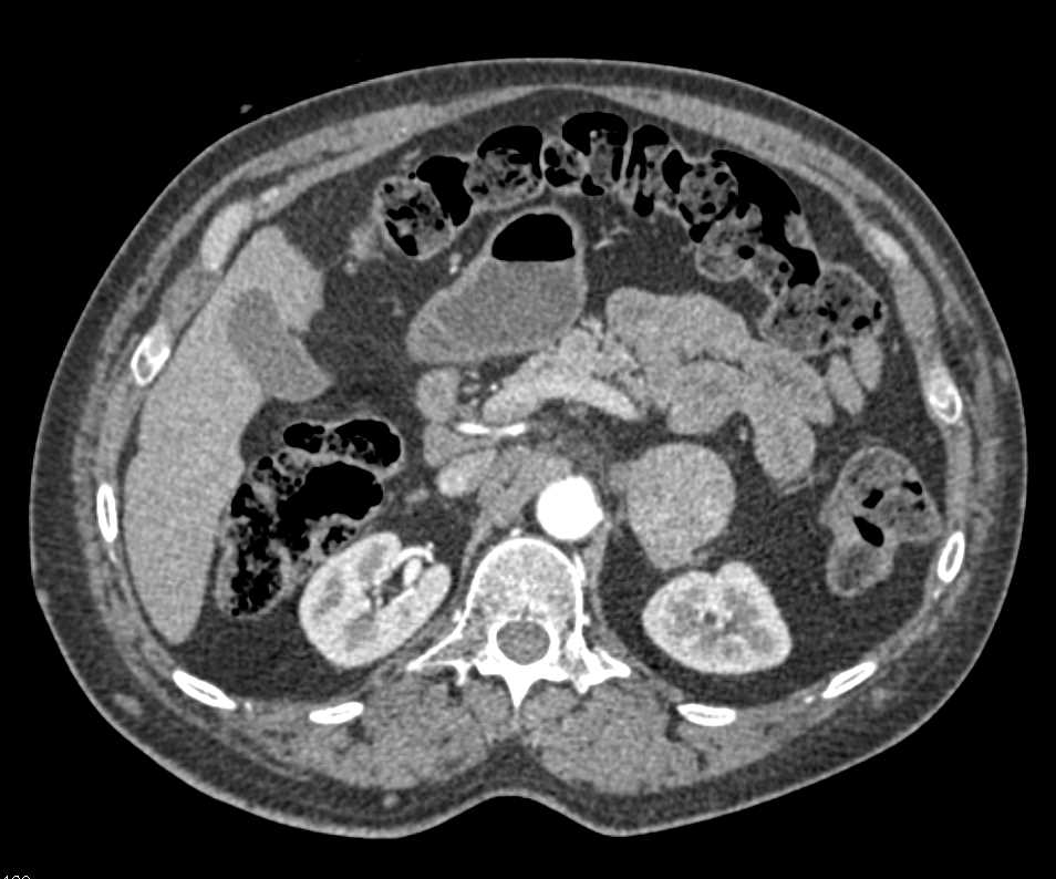 Pheochromocytoma Left Adrenal Gland in Patient with Neurofibromatosis - CTisus CT Scan