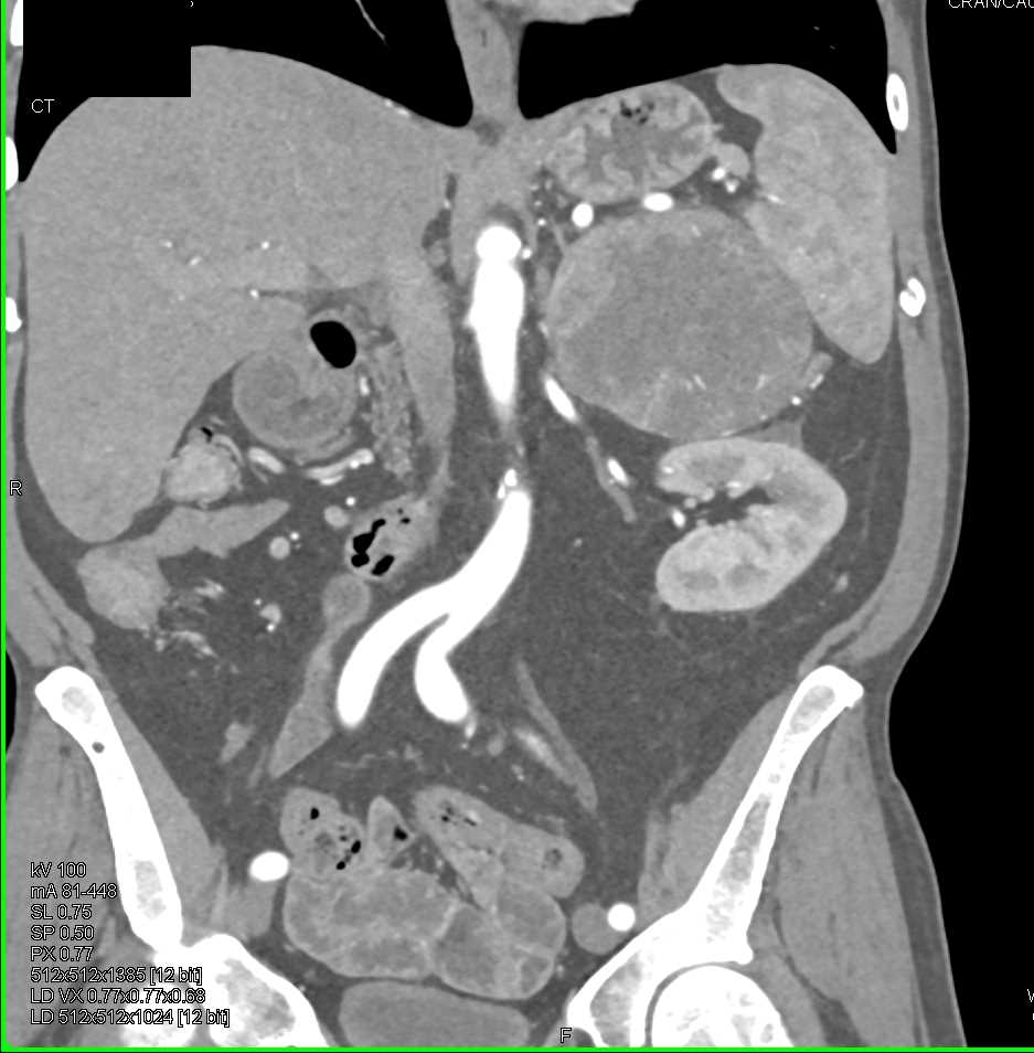 Primary Adrenal Carcinoma - CTisus CT Scan