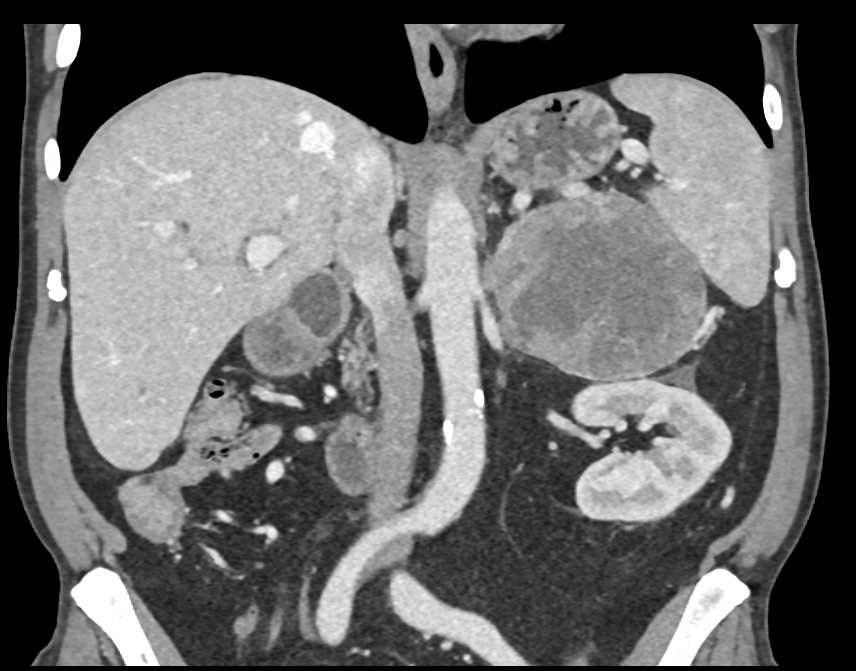 Primary Adrenal Carcinoma - CTisus CT Scan