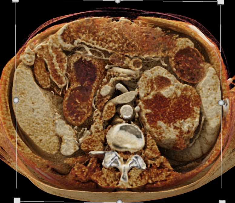 Primary Adrenal Carcinoma with Cinematic Rendering - CTisus CT Scan