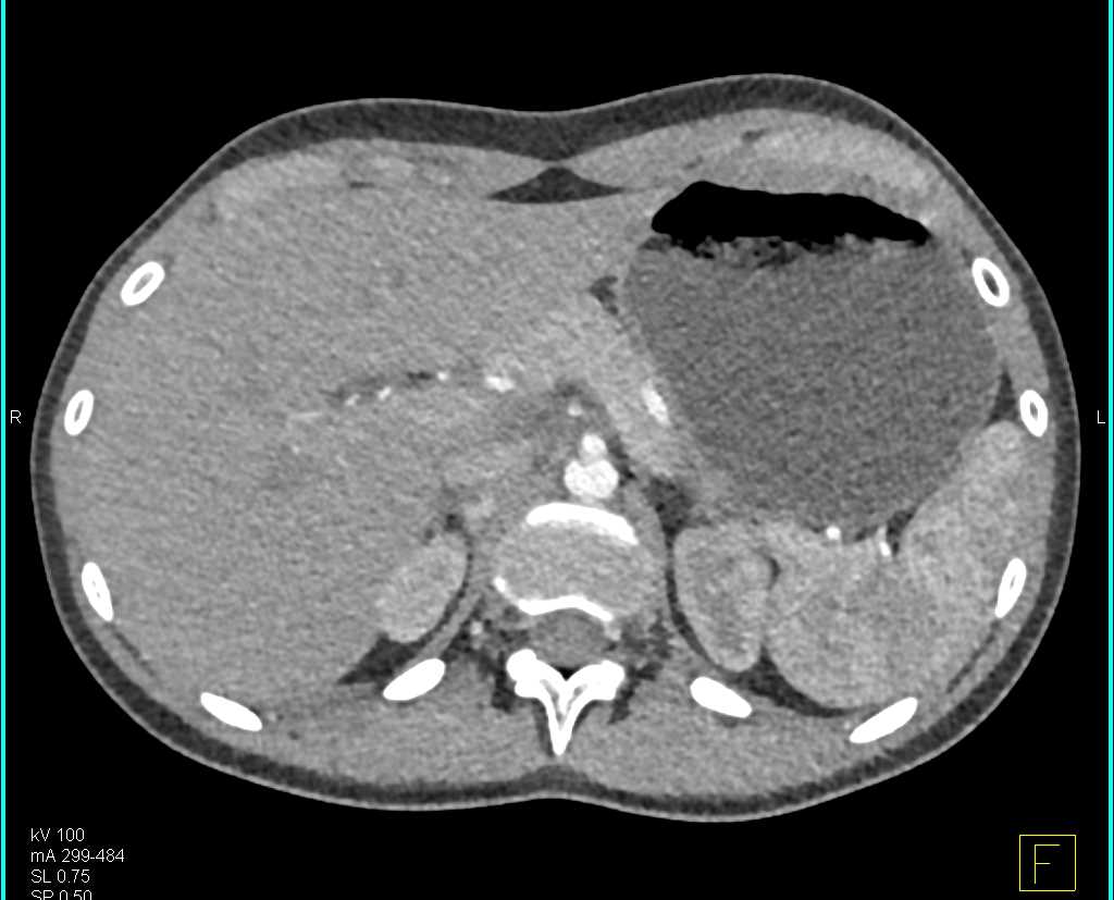 Pheochromocytoma Right Adrenal Gland and Pancreatic Neuroendocrine Tumor (PNET) Head of Pancreas - CTisus CT Scan