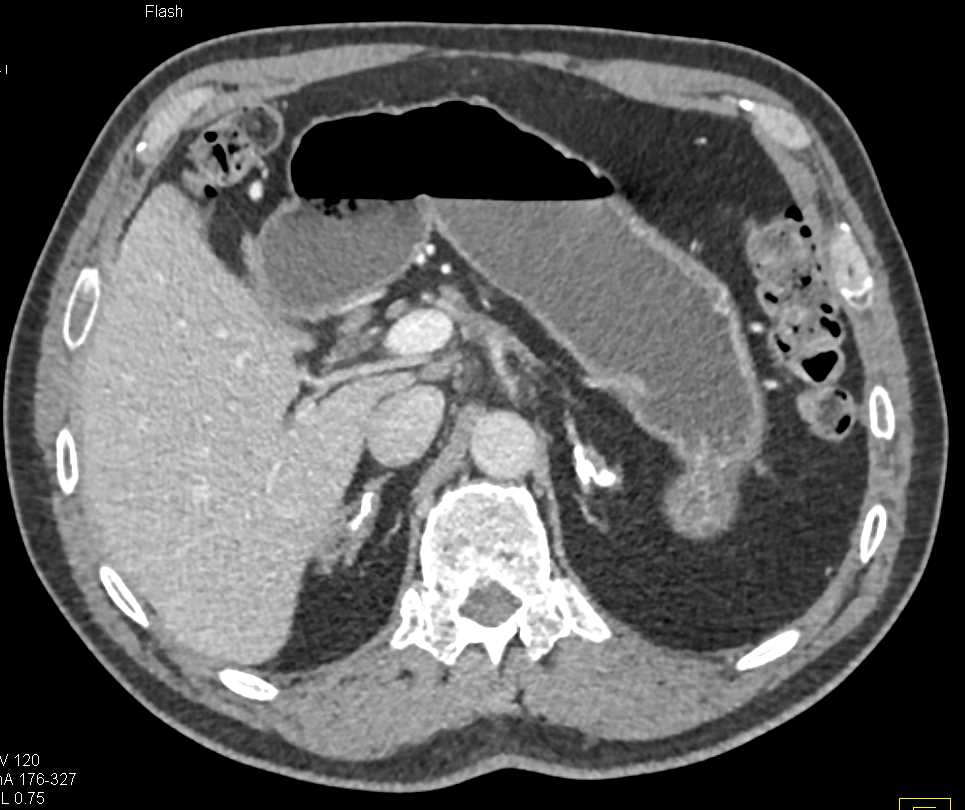 Calcified Adrenal Glands due to Prior Tuberculosis (TB) - CTisus CT Scan