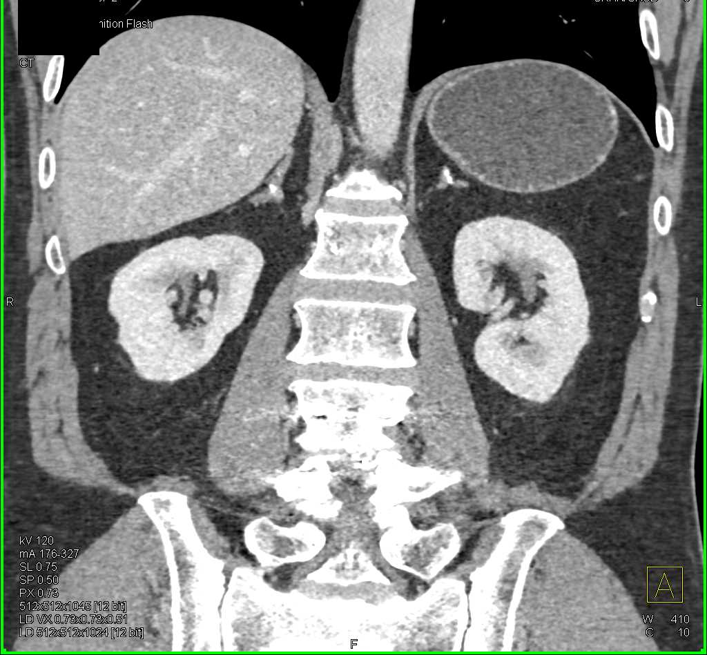 Calcified Adrenal Glands due to Prior TB - CTisus CT Scan