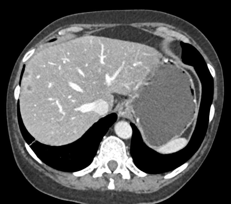 Pancreatic Adenocarcinoma with Liver Metastases - CTisus CT Scan