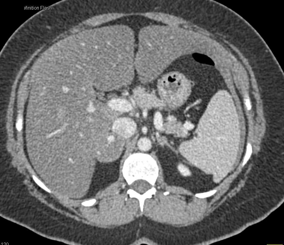 Vascular Adenoma Right Adrenal Gland - CTisus CT Scan