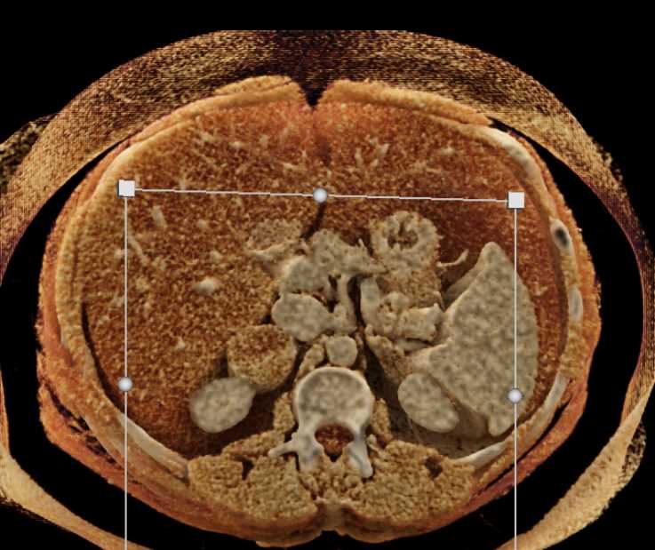 Vascular Adenoma Right Adrenal Gland - CTisus CT Scan