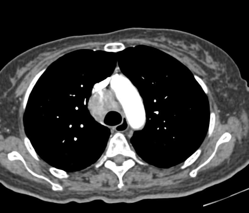 B-Cell Lymphoma - CTisus CT Scan