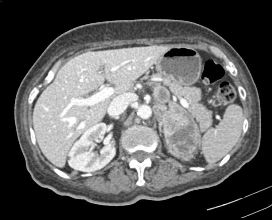 B-Cell Lymphoma - CTisus CT Scan