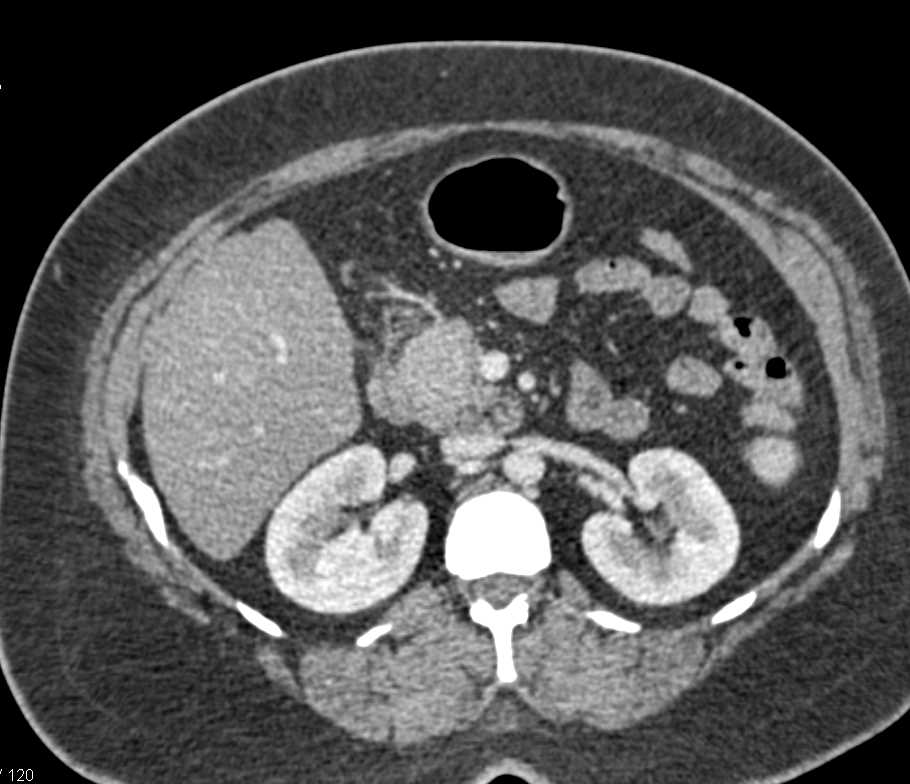 Pancreatic Neuroendocrine Tumor (PNET) Head of Pancreas - CTisus CT Scan