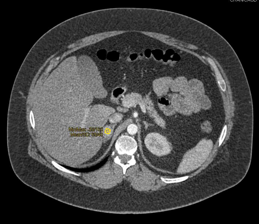 Adrenal Adenoma with Enhancement Like A Pheochromocytoma - CTisus CT Scan
