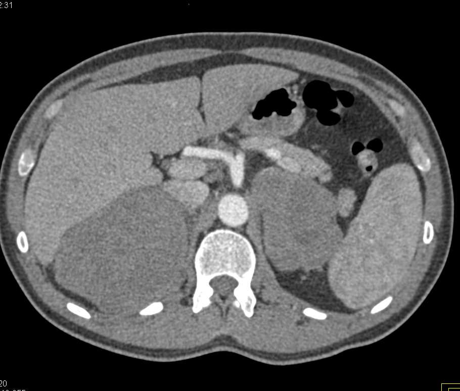 Primary Adrenal Lymphoma - CTisus CT Scan