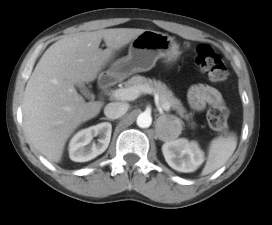 Adrenal Adenoma - CTisus CT Scan