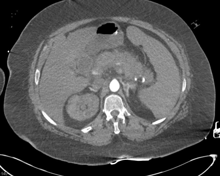 Hypotension with Bright Adrenals and Poor Renal Enhancement - CTisus CT Scan