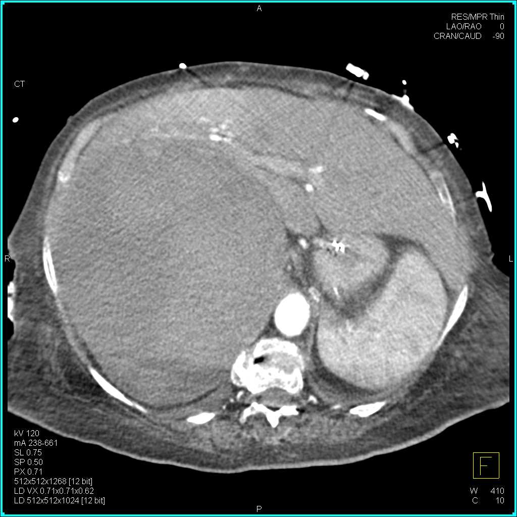 Large Right Adrenal Hematoma - CTisus CT Scan