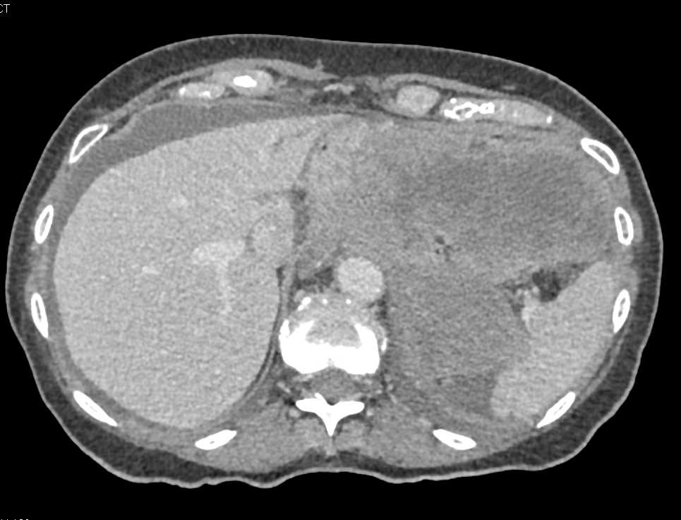 Ulcerating Gastric GIST Tumor Can Simulate Adrenal Mass - CTisus CT Scan