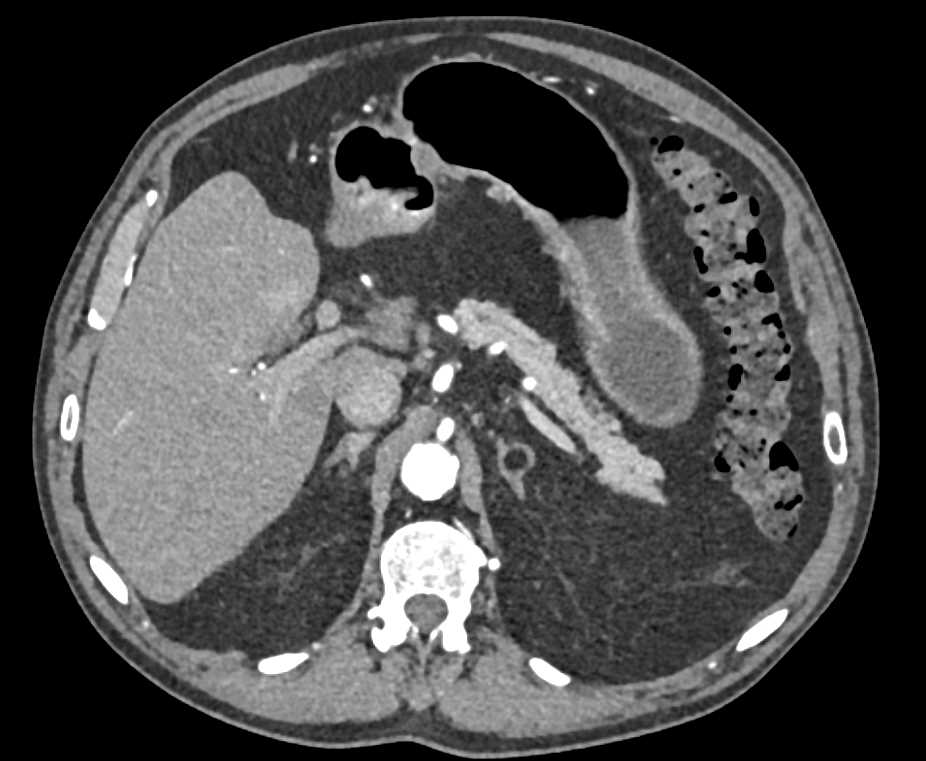 1cm Myelolipoma Left Adrenal Gland - CTisus CT Scan