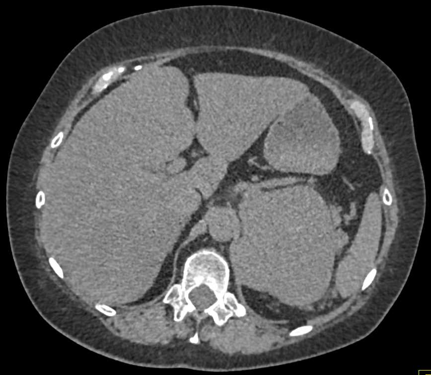 Primary Adrenal Cortical Carcinoma - CTisus CT Scan