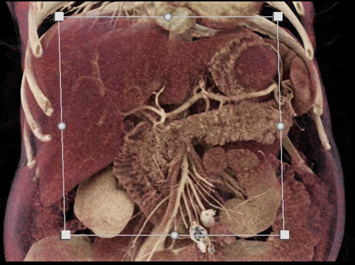 Primary Adrenal Cortical Carcinoma - CTisus CT Scan