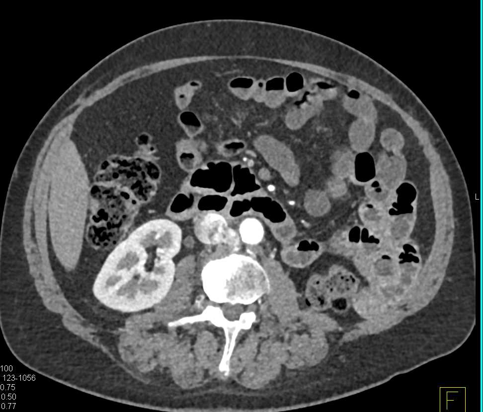 Paraganglioma - CTisus CT Scan