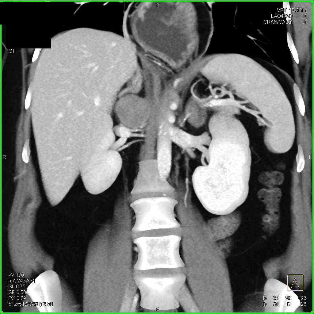 Unusual Right Paraganglioma Beneath the Adrenal - CTisus CT Scan