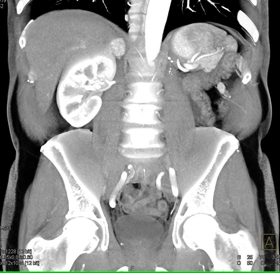 Right Adrenal Pheochromocytoma - CTisus CT Scan