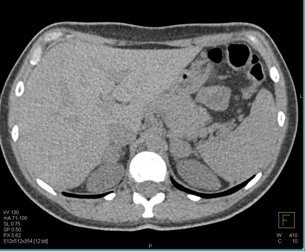 Bilateral Pheochromocytomas - CTisus CT Scan