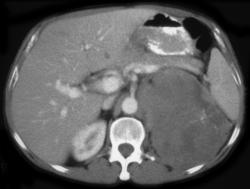 Adrenal Carcinoma - CTisus CT Scan