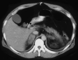 Bilateral Adrenal Hemorrhage - Adrenal Case Studies - CTisus CT Scanning