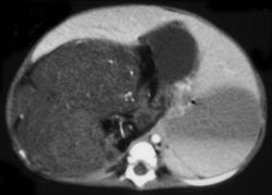 Teratoma of the Right Adrenal Gland - CTisus CT Scan