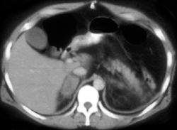 Adrenal Hemorrhage Resulted in Addison Crisis - CTisus CT Scan