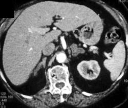 Adenomatous Adrenal Hyperplasia - CTisus CT Scan