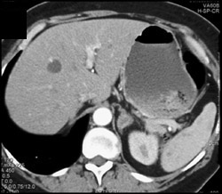 Bilateral Adenomas - CTisus CT Scan