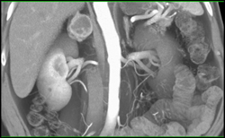 Metastatic Melanoma to the Right Adrenal - CTisus CT Scan