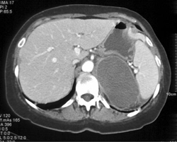 Cystic Adrenal Carcinoma - CTisus CT Scan