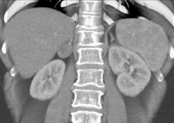 Right Adrenal Adenoma - CTisus CT Scan