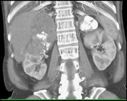 Metastatic Hepatoma to the Adrenal Glands-S/P Chemoembolization - CTisus CT Scan